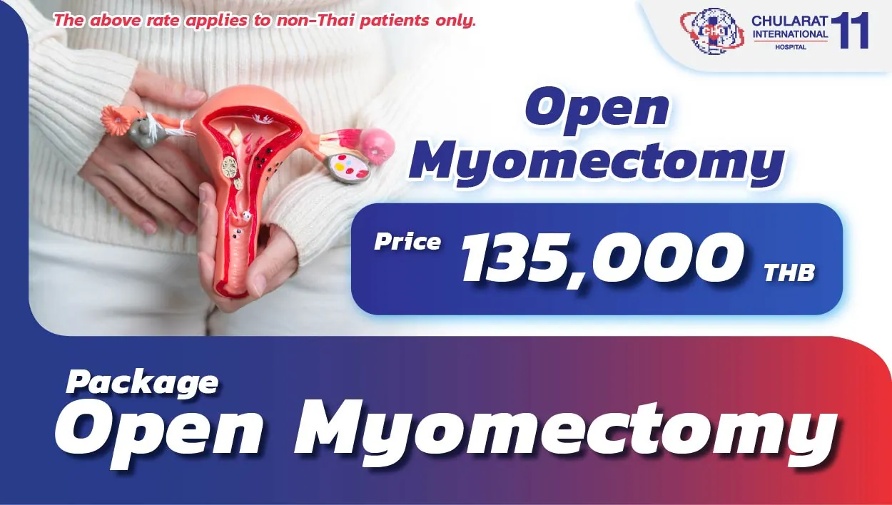 Open Myomectomy