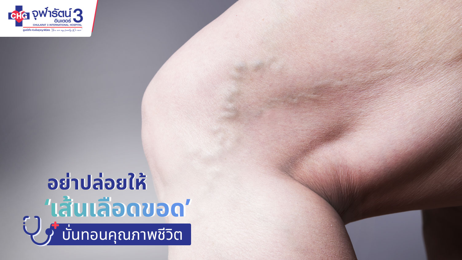 อย่าปล่อยให้ ‘เส้นเลือดขอด’ บั่นทอนคุณภาพชีวิต